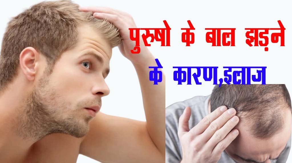 Causes and Treatment of Hair Loss in Men and Womenपुरुषों और महिलाओं में बाल झड़ने के कारण और इलाज।